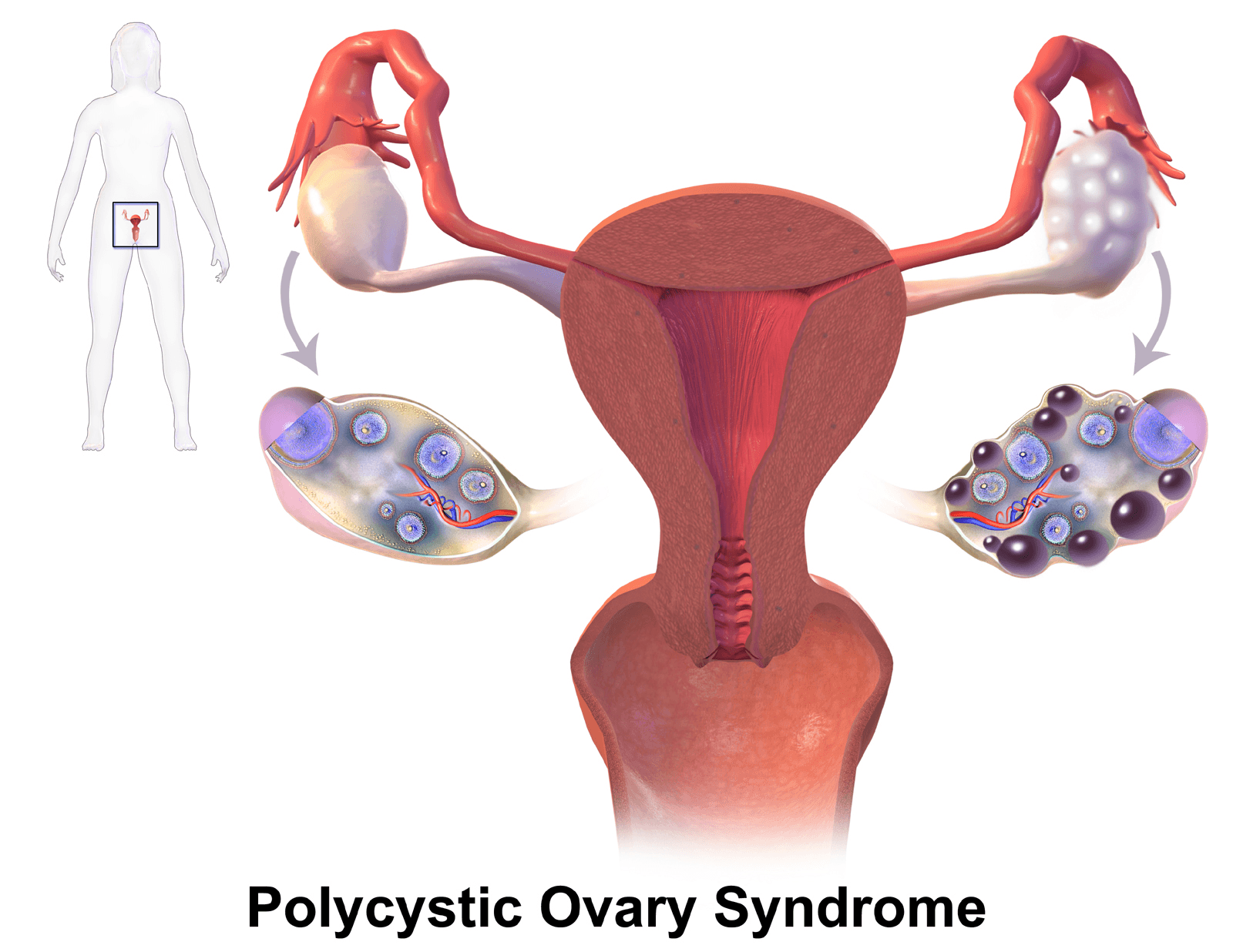 Polycystic Ovary Syndrome (PCOS)