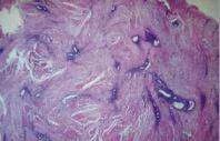 Endometriosis