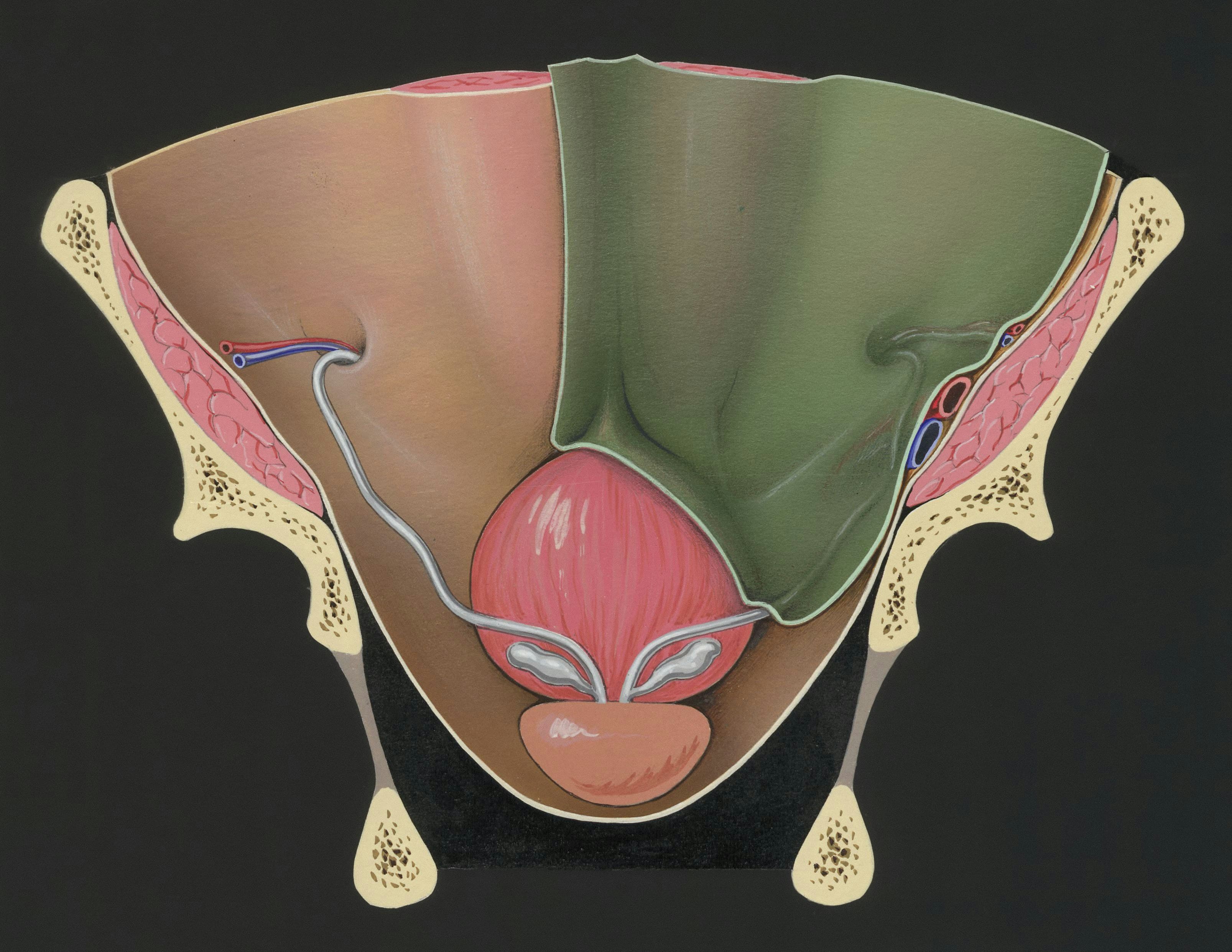 Endometriosis