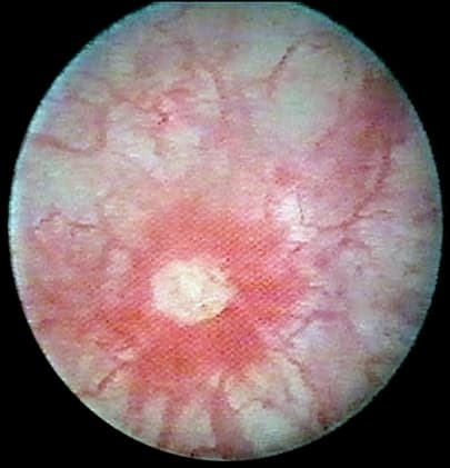 Interstitial Cystitis (Painful Bladder Syndrome)