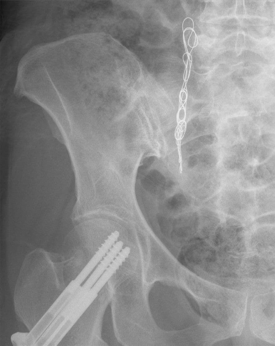 Pelvic Congestion Syndrome