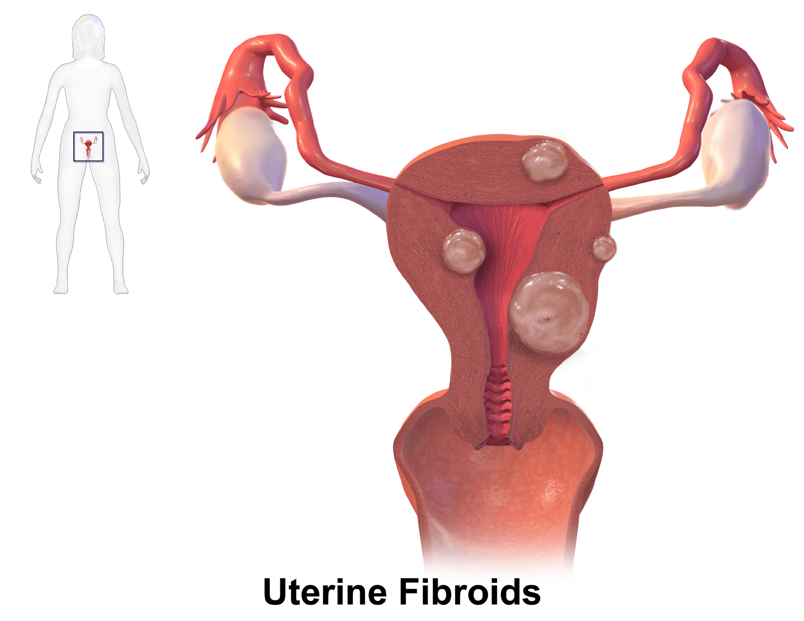 Uterine Fibroids (Leiomyomas)